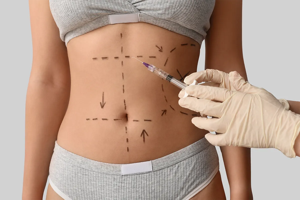Abdominoplastie à Lyon