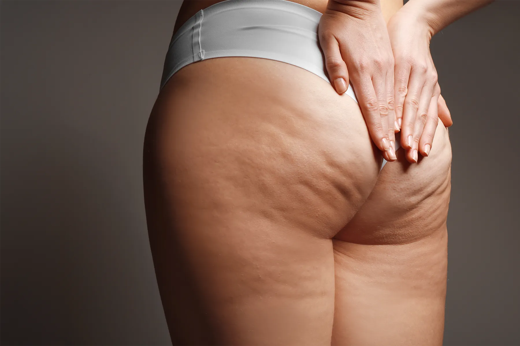 Eliminer la cellulite à Lyon