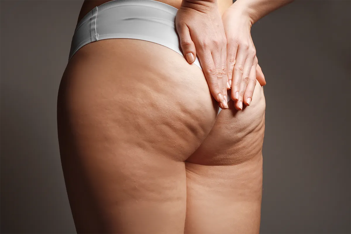 Eliminer la cellulite à Lyon