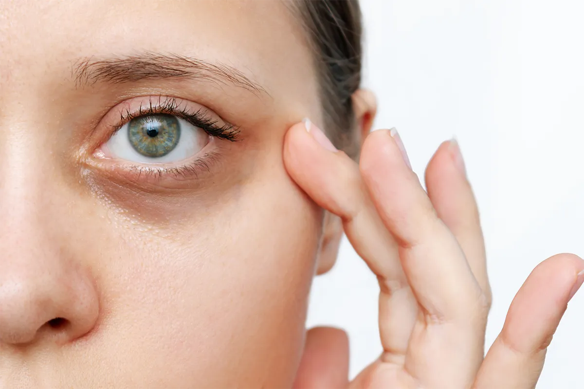 Traitement des cernes à Lyon : creux, coloration, poches… quelles solutions selon votre type de cerne ?