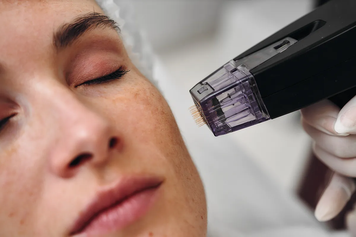 Microneedling du visage avec stylo à micro-aiguilles pour stimuler le renouvellement cutané et la qualité de peau.