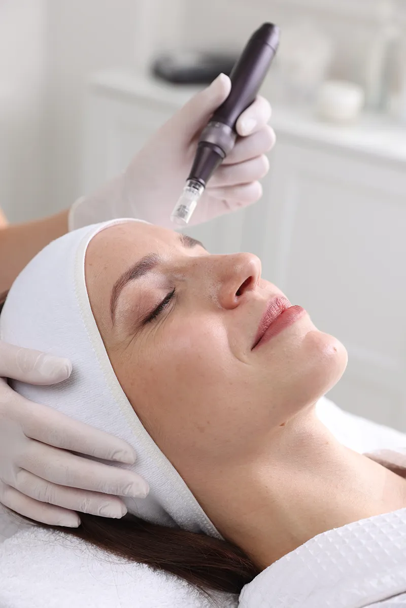 Microneedling du visage pour atténuer les rides fines et améliorer la fermeté et la qualité de peau.