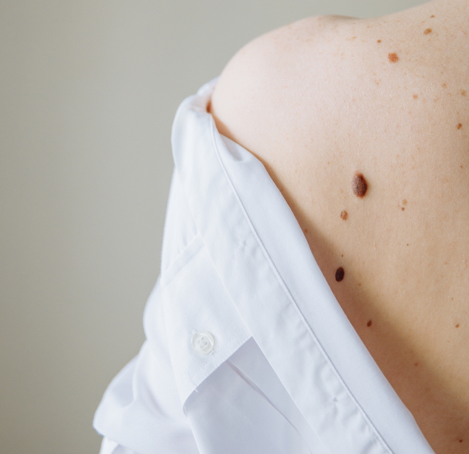 Chirurgie dermatologique